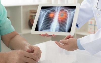 Ung thư phổi có phải do di truyền không, phòng ngừa thế nào?