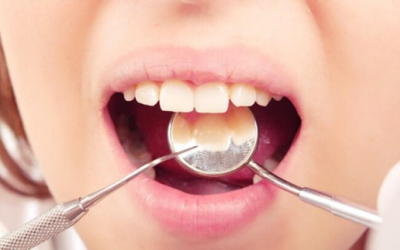 Viêm tủy răng do đâu?