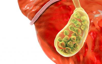 Sỏi lấp đầy túi mật có dùng Kim Đởm Khang được không?