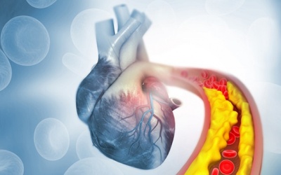 Hở van 2 lá 3/4, mỡ máu cao đã phải thay van chưa?