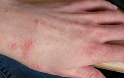 Trị bệnh ghẻ nước tại nhà với 4 nguyên liệu tự nhiên