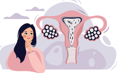 Những điều cần biết về phẫu thuật u nang buồng trứng