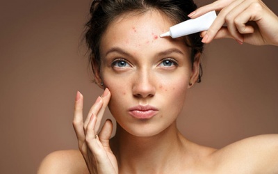 Dùng dầu mù u trị mụn trứng cá tốt không, cần lưu ý gì?