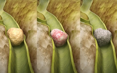 Làm thế nào để xác định chính xác thành phần của sỏi mật?