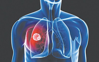 Kéo dài tuổi thọ cho người bị ung thư phổi giai đoạn cuối