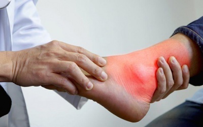 4 cách cải thiện bệnh gout ở mắt cá chân an toàn, hiệu quả