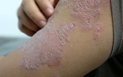 Thực phẩm giúp kiểm soát bệnh vẩy nến trong mùa Đông