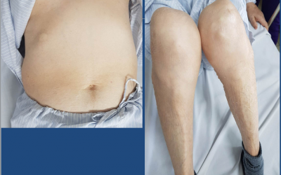 Cảnh báo: Teo cơ tứ chi, suy tuyến thượng thận do lạm dụng corticoid