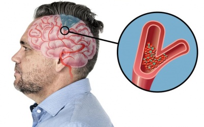 6 dấu hiệu cảnh báo cơn đột quỵ nguy hiểm sắp xảy ra