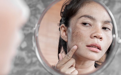 5 hoạt chất dưỡng trắng dành cho da không đều màu