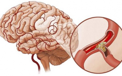 Giúp người bị tai biến mạch máu não nhanh hồi phục bằng cách nào?