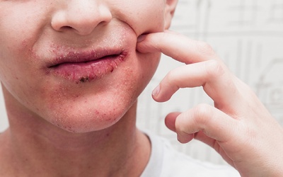 Cách kiểm soát bệnh vảy nến da mặt hiệu quả