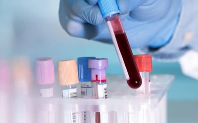 Chỉ số mỡ máu ở người khỏe mạnh theo tuổi và giới tính