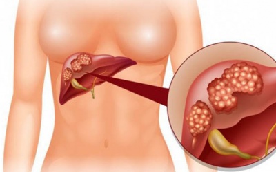 Điều trị u gan ác tính giai đoạn đầu thế nào?