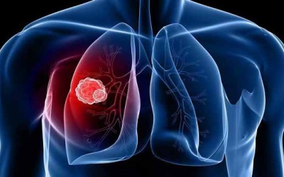 Bệnh u phổi có chữa được không?