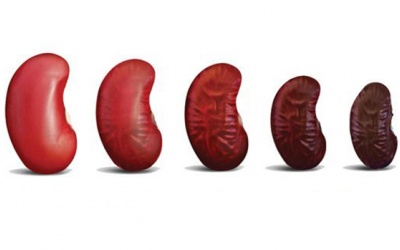 Cần làm gì để ngăn ngừa suy thận trở nên nặng hơn?