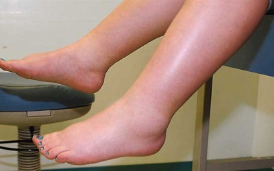 Làm thế nào khi mắt cá chân bị sưng phù?