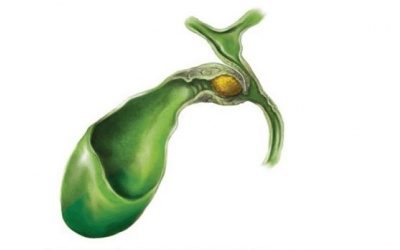 Sỏi kẹt cổ túi mật: Triệu chứng, biến chứng và điều trị thế nào?