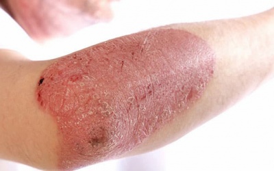Các phương pháp điều trị vảy nến thể mảng 