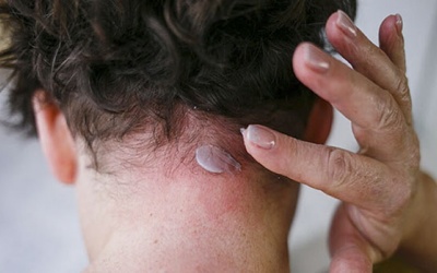 Vảy nến da đầu nên bôi thuốc gì cho hiệu quả nhanh?