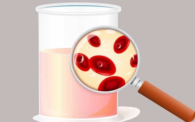 Tiểu ra máu là dấu hiệu của bệnh gì?