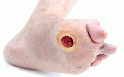 Cách chăm sóc bàn chân cho người bệnh đái tháo đường