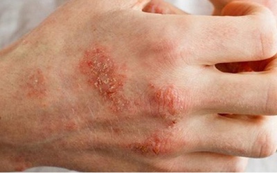 Cách kiểm soát bệnh chàm đơn giản bằng các nguyên liệu tự nhiên