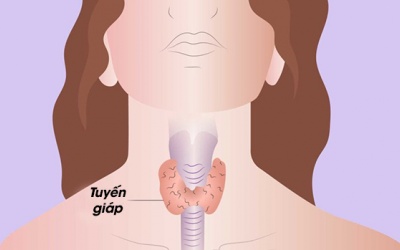 Người bị suy giáp nên có chế độ ăn uống như thế nào?