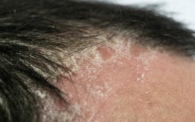 Người bị vảy nến da đầu làm thế nào để điều trị hiệu quả?