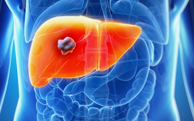 Uống cà phê giúp giảm nguy cơ mắc ung thư biểu mô tế bào gan?