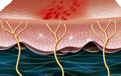 Cách giảm đau sau zona thần kinh hiệu quả