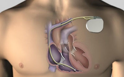 Đã đặt máy tạo nhịp nhưng vẫn hồi hộp, tim đập nhanh là sao?