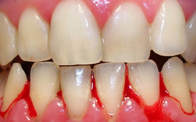 Bạn nên biết: 6 “thủ phạm” gây chảy máu chân răng