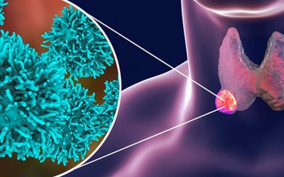 U tuyến giáp có nguy hiểm không? 