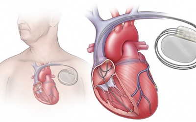 Liệu pháp tái đồng bộ tim - “cứu cánh” cho người rối loạn nhịp tim
