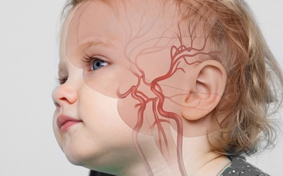 Bé 3 tuổi đột quỵ do túi phình mạch máu não
