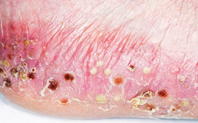 Dấu hiệu nhận biết bệnh vảy nến thể mủ 