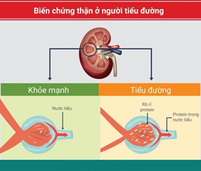 Vì sao biến chứng suy thận lại nguy hiểm với người tiểu đường?