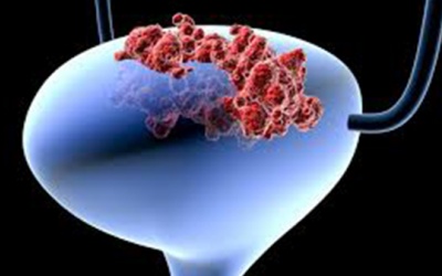 Cách giảm tác dụng phụ của hóa trị ung thư bàng quang hiệu quả