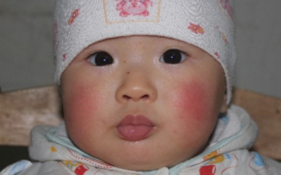 Trẻ bị nẻ má, mẹ phải làm thế nào?
