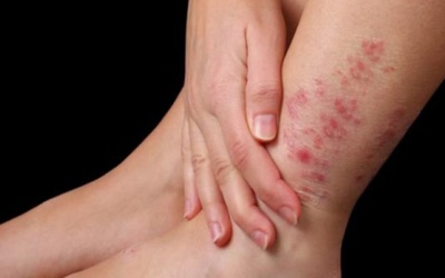 Khi bị viêm da cơ địa nên kiêng thực phẩm nào?