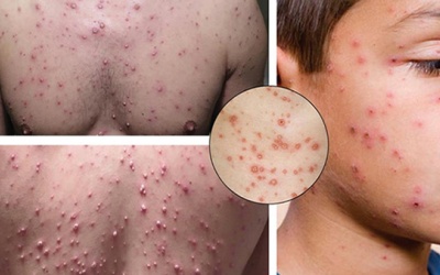 Bí quyết xóa tan sẹo thủy đậu bằng phương pháp tự nhiên