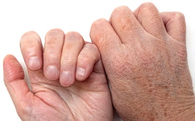 Bàn tay nứt nẻ đến chảy máu phải làm sao?