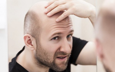 Nên dùng thuốc nào để trị hói đầu?