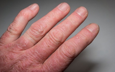 Bệnh viêm khớp vảy nến có nguy hiểm không?