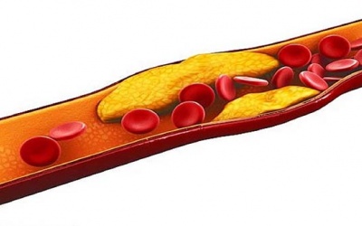 4 triệu chứng cảnh báo bệnh máu nhiễm mỡ