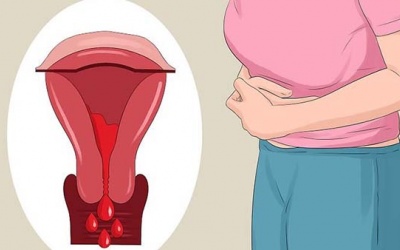 U nang buồng trứng trái có thai được không?