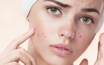 Trị mụn sau Tết, chị em cần lưu ý điều gì?