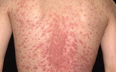 Bệnh vảy phấn hồng điều trị như thế nào?