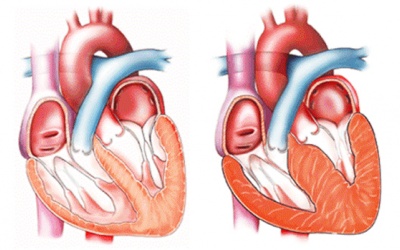 Dày thất trái là gì, có nguy hiểm hay không?